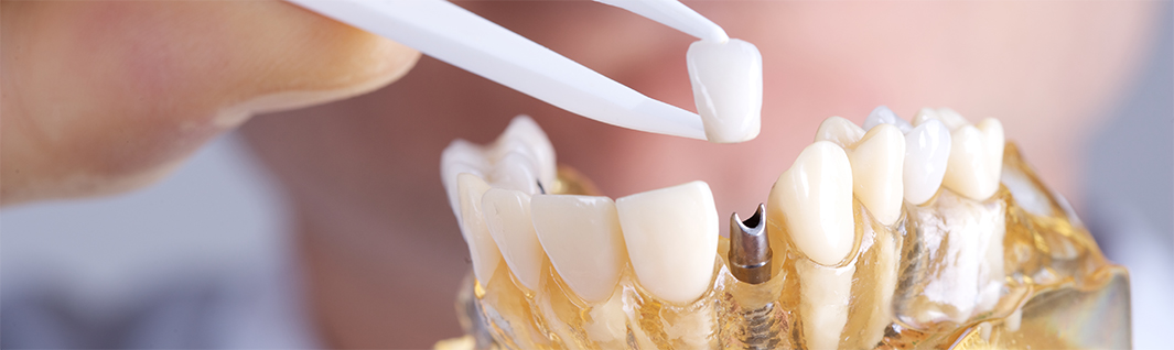 Wir verraten, warum das Zahnimplantat die beste Lösung sein kann.