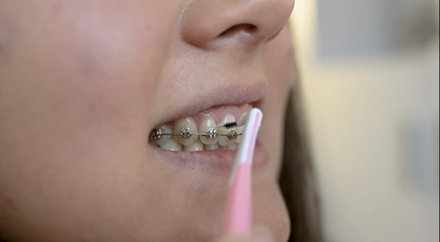 Herausforderung der Mundhygiene mit einer Zahnspange